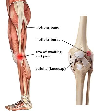 Repetitive Injuries: Why Rest Isn't Always the Best Medicine